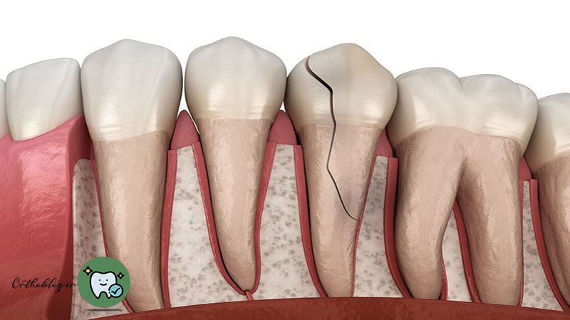 شکستگی دندان چیست؟