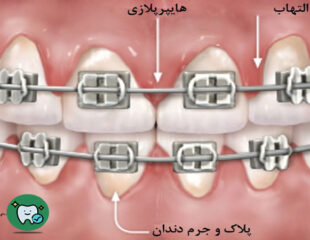 علت التهاب لثه در ارتودنسی