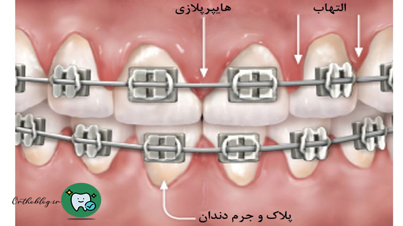 علت التهاب لثه در ارتودنسی