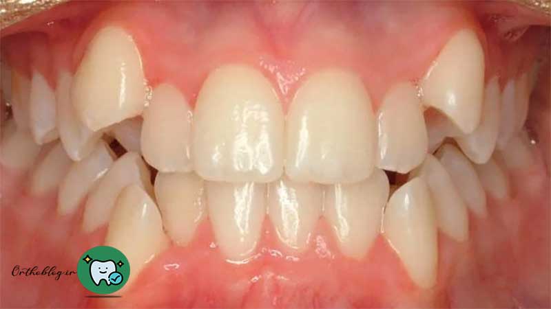 علت کشیدن دندان در ارتودنسی
