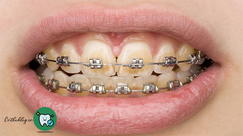 خطر پوسیدگی دندان