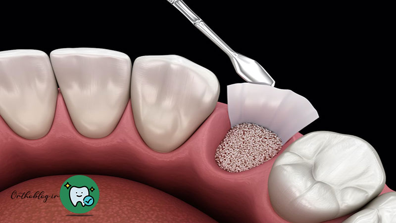 برداشت و قرار دادن مواد پیوند