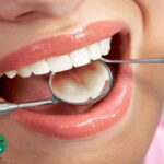 مراقبت های بعد از کامپوزیت دندان