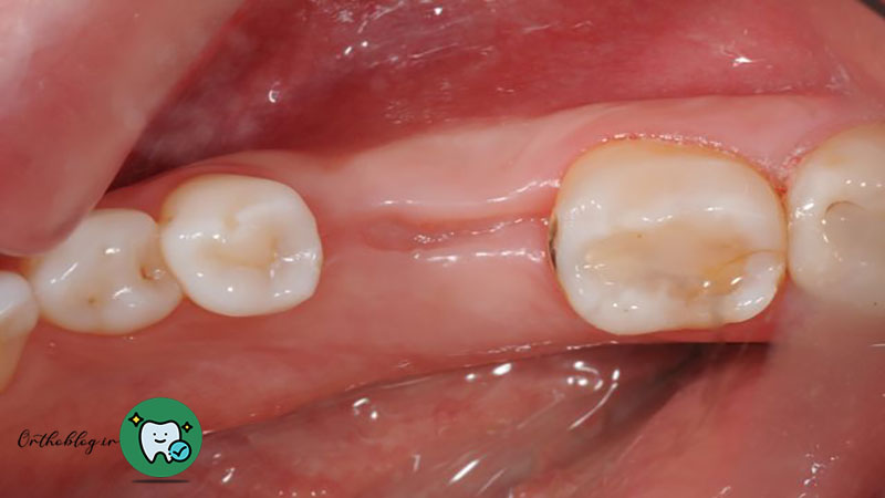 روند بهبودی پس از کشیدن دندان